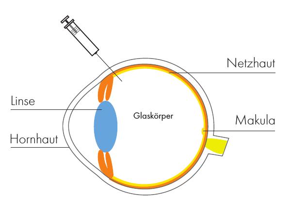 Medikamenteneingabe in den Glaskörper. Medikamenteneingabe in den Glaskörper.