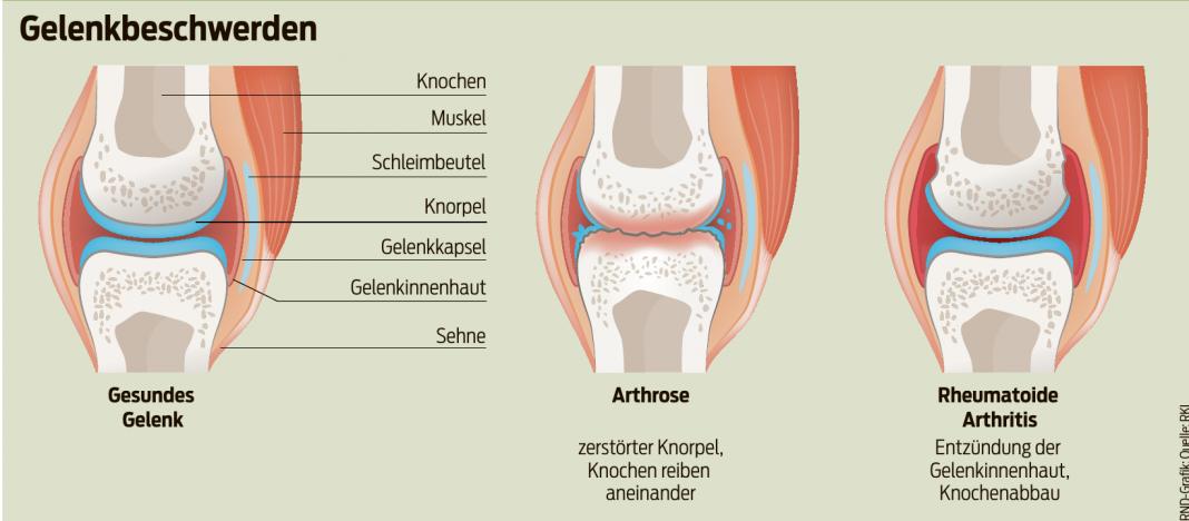 Bei Arthrose spielt Genetik eine Rolle - Gesundheit - Magdeburger ...