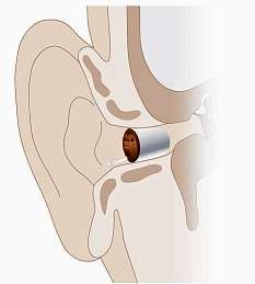 Im-Ohr-Hörsysteme sind von außen unsichtbar und werden individuell für jeden Träger angefertigt. Foto: OTON