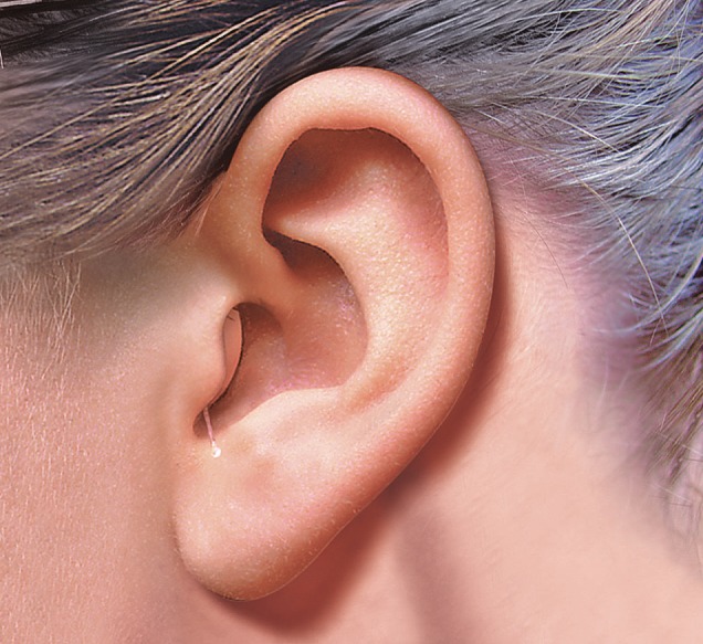 Die nahezu unsichtbaren Im-Ohr-Hörsysteme von OTON können im Rahmen einer Studie kostenlos getestet werden. Die Geräte sitzen direkt im Gehörgang und sind daher von außen kaum zu erkennen  Foto: OTON
