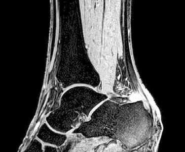 MRT-Bild einer Achillessehnenentzündung am Ansatz.