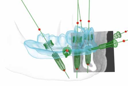 Mit Hilfe detailgenauer DVT-Fotos (rechter Bereich) erfolgt die gesamte Planung vor der OP am Computer