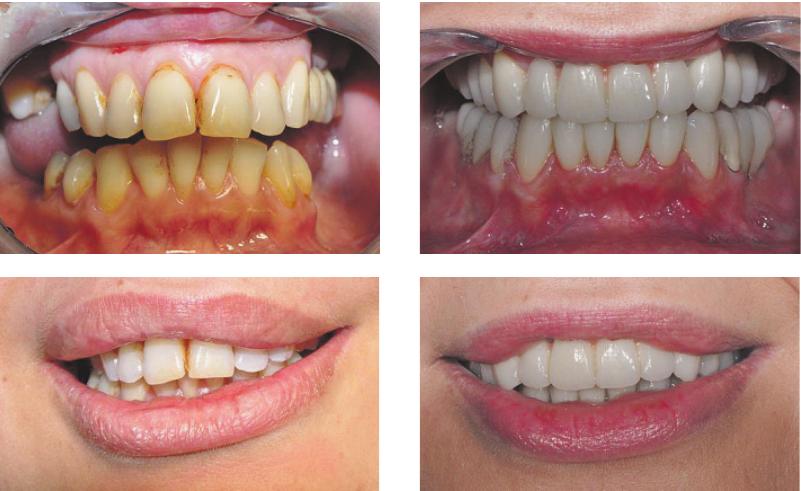 Die Fotos links zeigen die Zähne vor der Behandlung, und auf der rechten Seite ist das Ergebnis zu erkennen