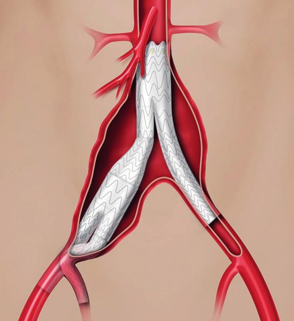 Aortenaneurysma Gesundheit/Pflege Peiner Allgemeine Zeitung