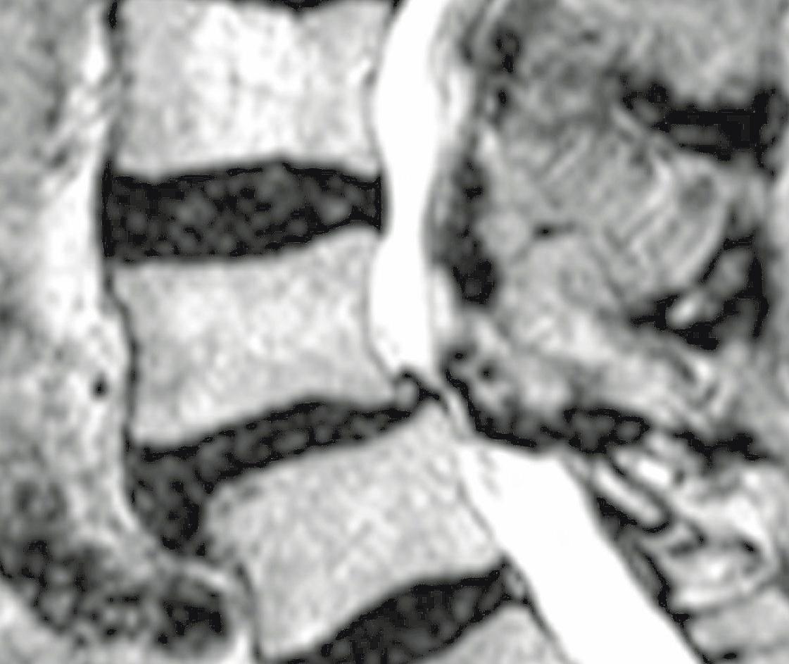 Die Lendenwirbelsäule mit einer Spinalkanalstenose. Die Lendenwirbelsäule mit einer Spinalkanalstenose.