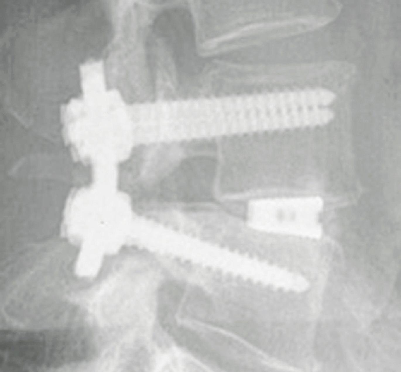 Die Stabilisierung der Wirbelsäule kann wie hier durch Implantate erfolgen. Fotos: St. Fanziskus-Hospital Die Stabilisierung der Wirbelsäule kann wie hier durch Implantate erfolgen. Fotos: St. Fanziskus-Hospital