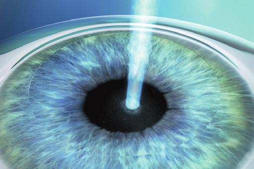 Bei den Augenlaserverfahren formt ein Excimerlaser das Hornhautgewebe innerhalb von Sekunden, um so die Fehlsichtigkeit auszugleichen. Bei den Augenlaserverfahren formt ein Excimerlaser das Hornhautgewebe innerhalb von Sekunden, um so die Fehlsichtigkeit auszugleichen.