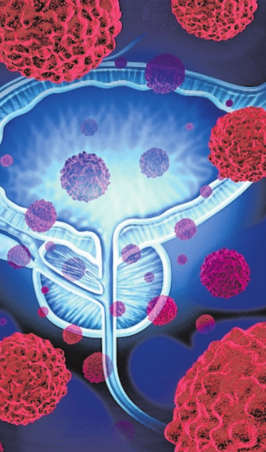 Bei einer Biopsie wird Gewebe entnommen und auf Krebszellen untersucht. FOTO: GETTY IMAGES Bei einer Biopsie wird Gewebe entnommen und auf Krebszellen untersucht. FOTO: GETTY IMAGES