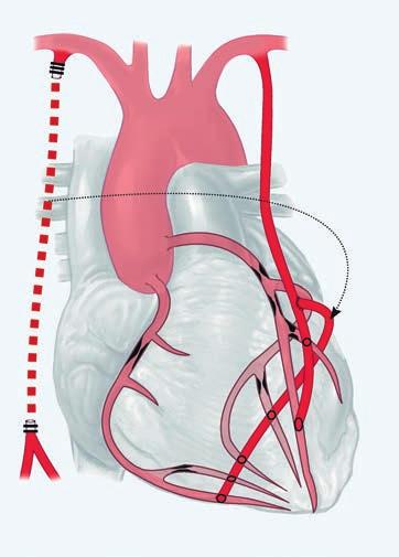 Komplett arterielle Bypassoperation: Die linke Brustwandarterie 1 versorgt die Herzkranzgefäße der Vorderwand. Die rechte Brustwandarterie 2 wird als freies Transplantat entnommen und im rechten Winkel in die linke Brustwandarterie eingenäht, um die Gefäße der Hinterwand zu versorgen. Grafik: Andreas C. Rieß