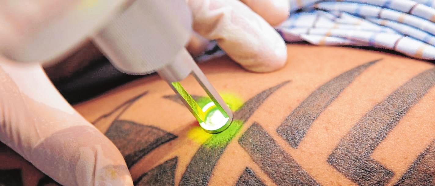Gerade großflächige Tattoos können nicht durch ein Cover-up verdeckt werden. Als letzte Rettung bleibt da oft nur die Laserbehandlung beim Spezialisten. BILD: DPA Gerade großflächige Tattoos können nicht durch ein Cover-up verdeckt werden. Als letzte Rettung bleibt da oft nur die Laserbehandlung beim Spezialisten. BILD: DPA