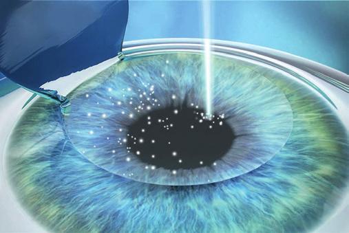 LASIK-Methode mit Mikrokeratom LASIK-Methode mit Mikrokeratom