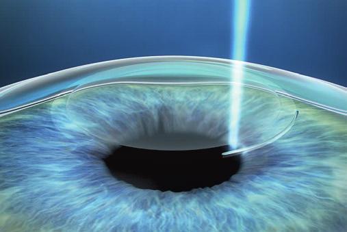 Femto-LASIK Femto-LASIK