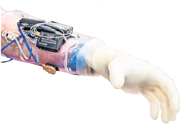 Hochmoderne Technik hilft, komfortable und leistungsfähige Armprothesen zu erstellen. Hochmoderne Technik hilft, komfortable und leistungsfähige Armprothesen zu erstellen.