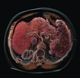 Leber-Scan: Der Photon-Counting-CT bietet neue Möglichkeiten in der Tumordiagnostik Herz-Scan: Untersuchung eines Herzens auf Verkalkungen mit dem Naeotom Alpha