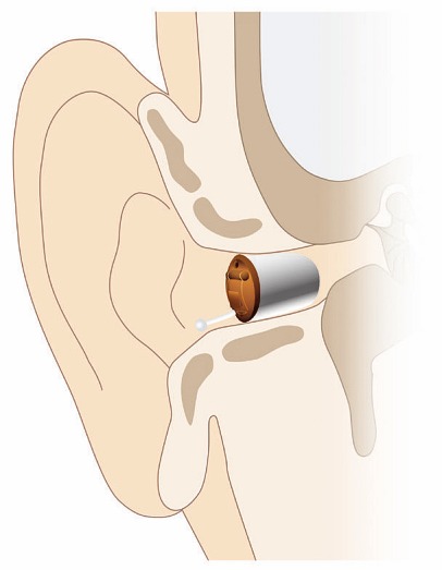Die Grafik zeigt die Position, in der ein Im-Ohr-Hörgerät im Gehörgang sitzt