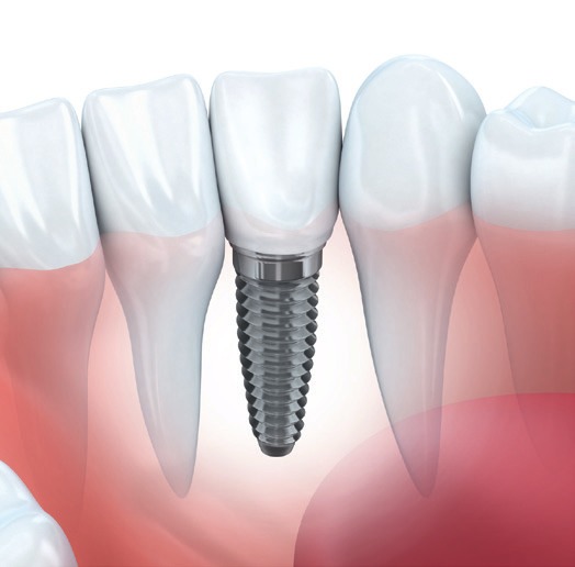 Endlich wieder in einen Apfel beißen: Mit den fest sitzenden Implantaten ist das kein Problem, © proDente e.V./Johann Peter Kierzkowski, vladru/123RF Endlich wieder in einen Apfel beißen: Mit den fest sitzenden Implantaten ist das kein Problem, © proDente e.V./Johann Peter Kierzkowski, vladru/123RF