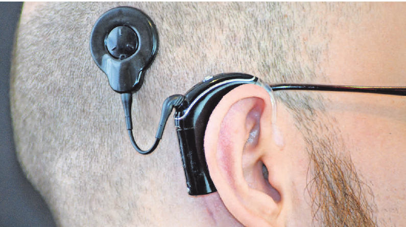 Ein Cochlea-Implantat ist eine Hörprothese, die auch Gehörlosen und Ertaubten das Hören wieder ermöglichen kann. Foto: Bernd/stock.adobe.com Ein Cochlea-Implantat ist eine Hörprothese, die auch Gehörlosen und Ertaubten das Hören wieder ermöglichen kann. Foto: Bernd/stock.adobe.com