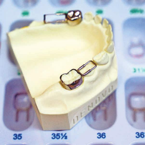 Wird der Milchzahn gezogen, versorgt man den Nachbarzahn mit einer Metallschleife und Platzhalter – hier auf einem Abdruck zu sehen. Wird der Milchzahn gezogen, versorgt man den Nachbarzahn mit einer Metallschleife und Platzhalter – hier auf einem Abdruck zu sehen.