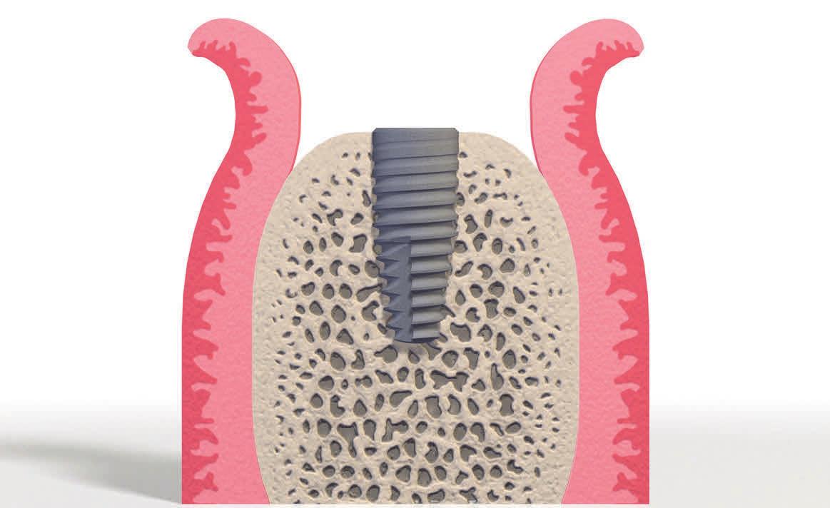 Implantat im Knochen. Fotoquelle: Strautmann Implantat im Knochen. Fotoquelle: Strautmann
