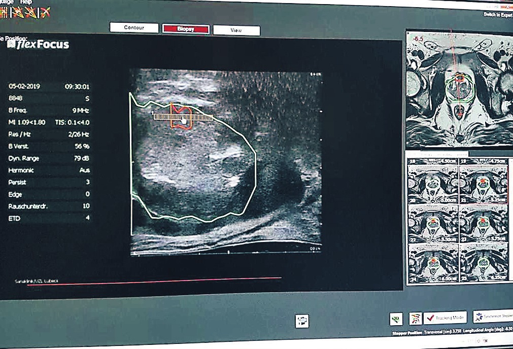 Mithilfe modernster 3-D-Technik können MRT-Bilder und die Ultraschall-Aufnahme fusioniert werden. Mithilfe modernster 3-D-Technik können MRT-Bilder und die Ultraschall-Aufnahme fusioniert werden.
