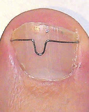 Ein eingewachsener Zehennagel ist schmerzhaft. Eine Nagelkorrekturspange, auch Orthonyxiespange genannt, kann Abhilfe schaffen. Das Podologiezentrum Behrens berät Betroffene ausführlich. Ein eingewachsener Zehennagel ist schmerzhaft. Eine Nagelkorrekturspange, auch Orthonyxiespange genannt, kann Abhilfe schaffen. Das Podologiezentrum Behrens berät Betroffene ausführlich.