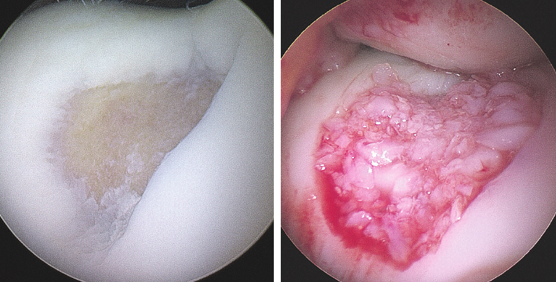 Links ein ausgeprägter Knorpelschaden im Kniescheibenlager, rechts nach Durchführung des Minced Cartilage-Verfahrens mit eigenen Knorpelzellen