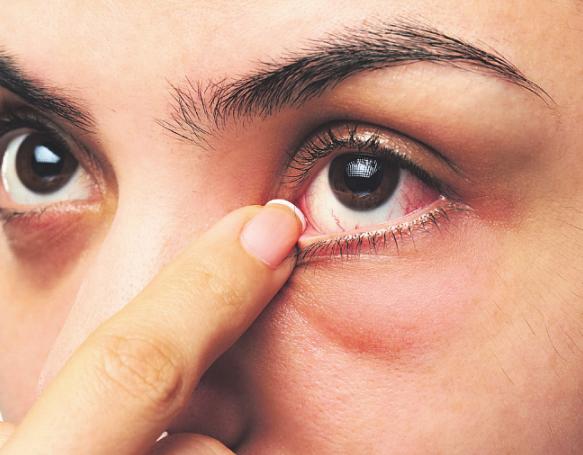 Allergien können das Sehvermögen beeinträchtigen. Foto: PixieMe/ stock.adobe.com Allergien können das Sehvermögen beeinträchtigen. Foto: PixieMe/ stock.adobe.com