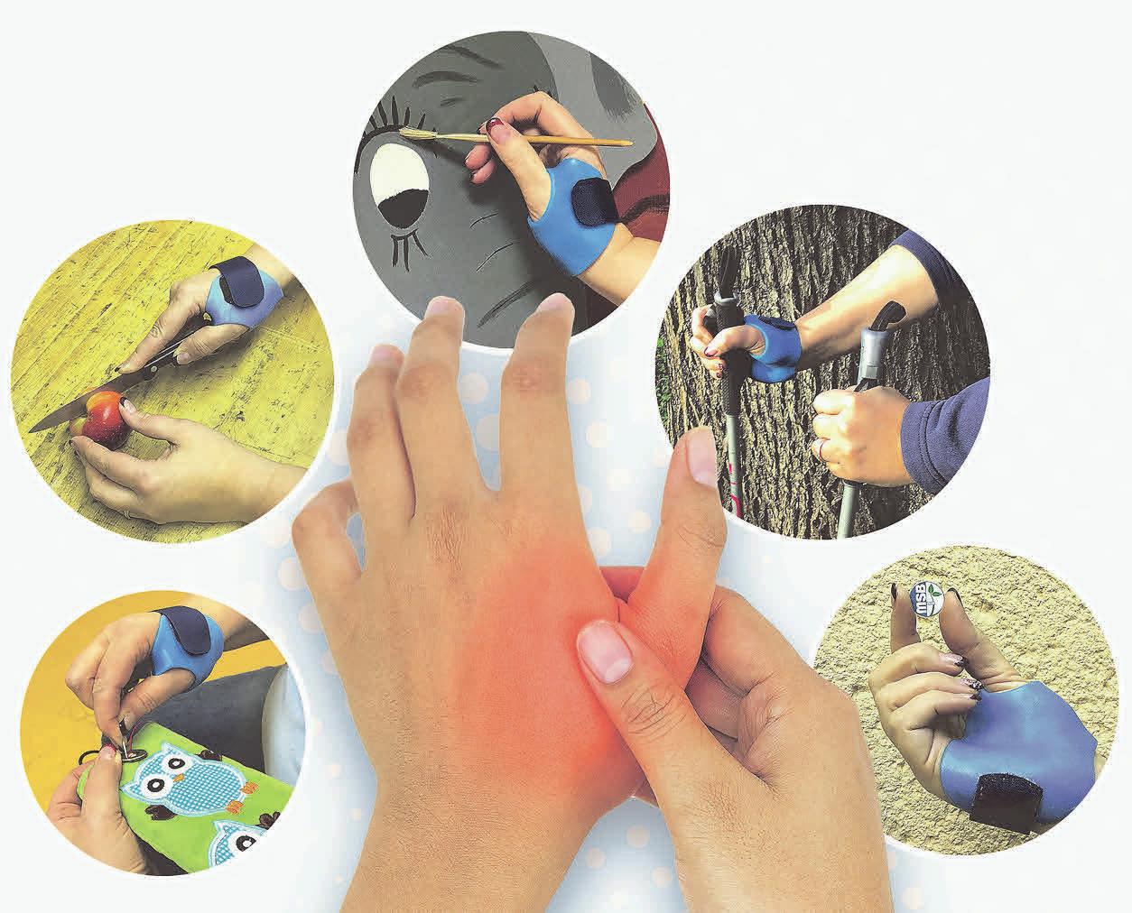 DIE NEU ENTWICKELTE Rhizarthrose Extensions Orthese (R.E.O.) kann Patienten zahlreiche Handgriffe im Alltag erleichtern. Foto: MSB-Orthopädie-Technik GmbH Leipzig DIE NEU ENTWICKELTE Rhizarthrose Extensions Orthese (R.E.O.) kann Patienten zahlreiche Handgriffe im Alltag erleichtern. Foto: MSB-Orthopädie-Technik GmbH Leipzig