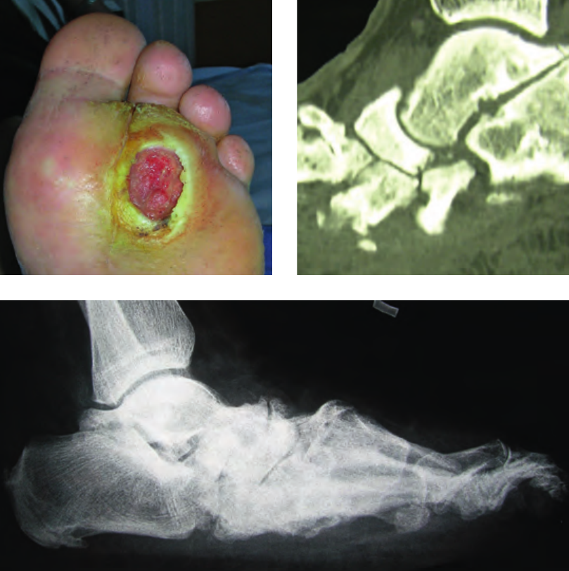Charcot-Fuß: Infiziertes Geschwür, Knochenzerstörung und Deformierung in CT und Röntgen. Foto: Hendrik Lüders