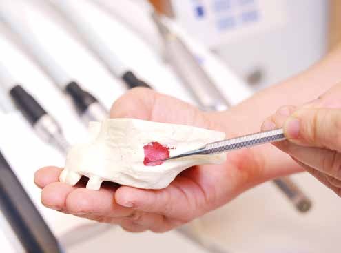 Detailfoto 2: Der Sinuslift schafft die Stabilität und das benötigte Knochenlager für das spätere Implantat. Detailfoto 2: Der Sinuslift schafft die Stabilität und das benötigte Knochenlager für das spätere Implantat.