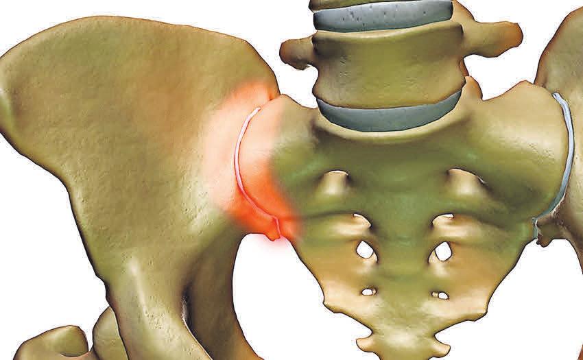 Bandscheibe oder ISG? Ärzte können die richtige Diagnose stellen. FOTO: IFUSE-IMPLANTAT Bandscheibe oder ISG? Ärzte können die richtige Diagnose stellen. FOTO: IFUSE-IMPLANTAT